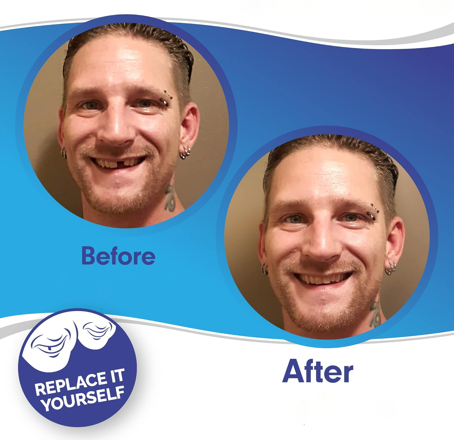 Veneers For Upper And Lower Teeth Complete Smile Transformation Kit
