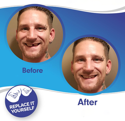 Veneers For Upper And Lower Teeth Complete Smile Transformation Kit