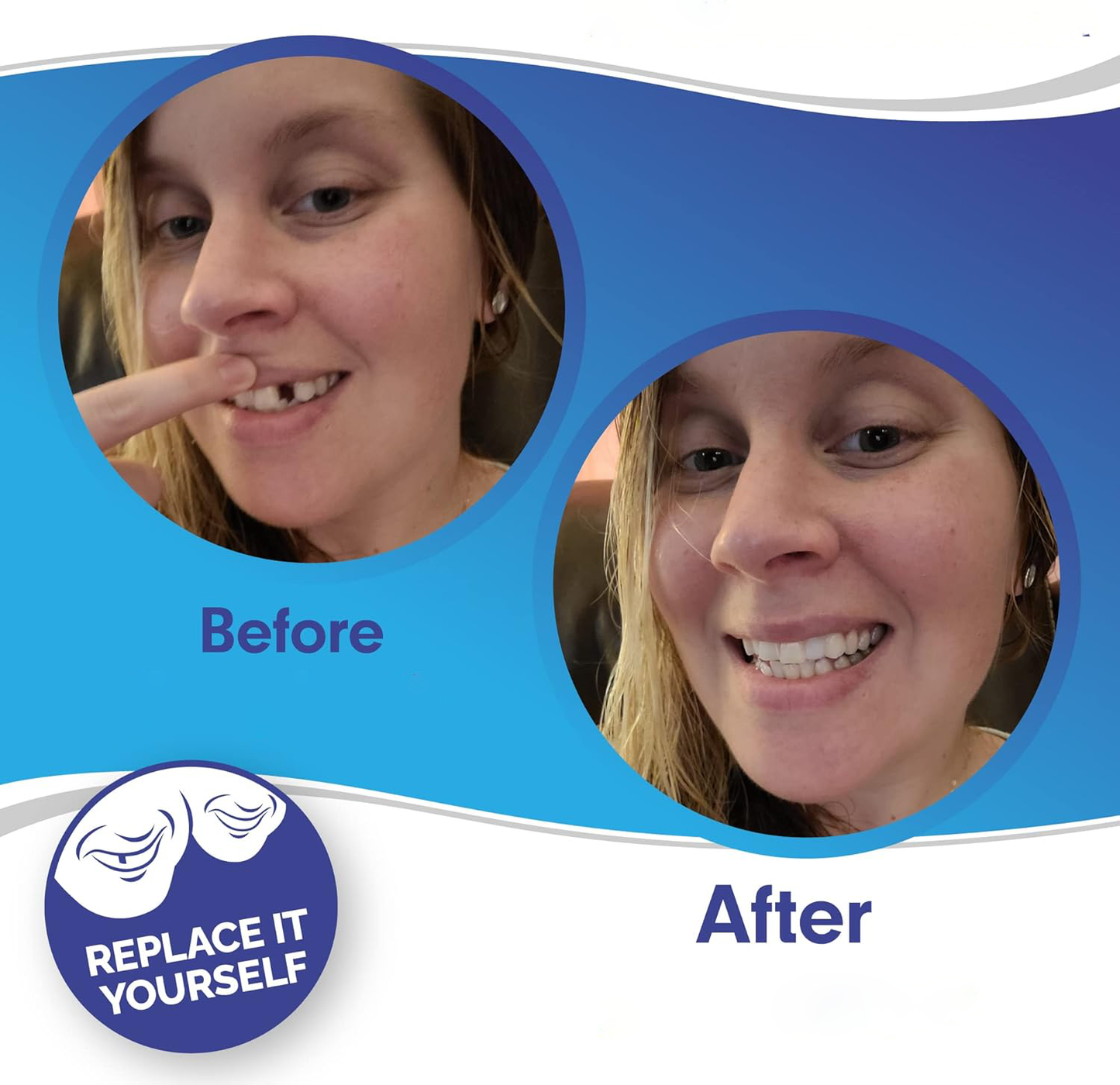 Veneers For Upper And Lower Teeth Complete Smile Transformation Kit