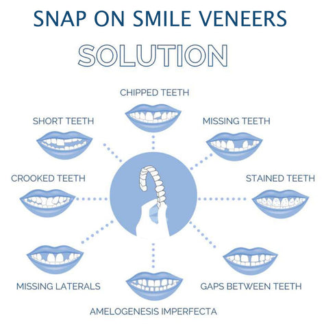 Veneers For Upper And Lower Teeth Complete Smile Transformation Kit