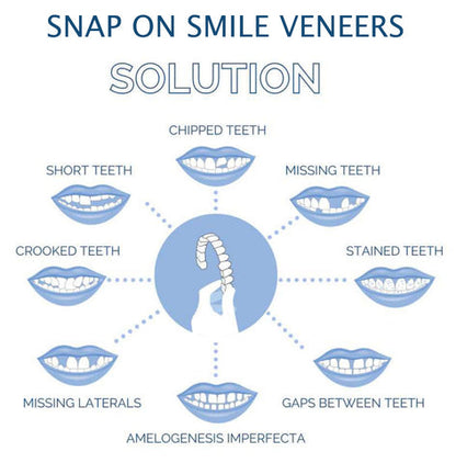 Veneers For Upper And Lower Teeth Complete Smile Transformation Kit
