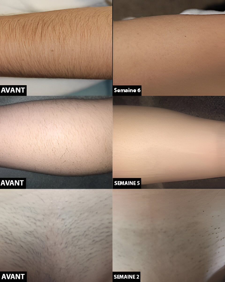 Laser Hair Removal For Long-Term Smooth Skin And Reduced Regrowth