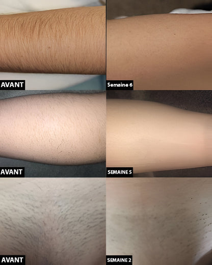 Laser Hair Removal For Long-Term Smooth Skin And Reduced Regrowth
